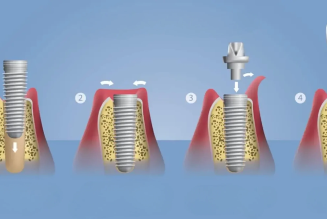 زراعة اسنان