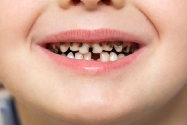  تسوس أسنان الأطفال