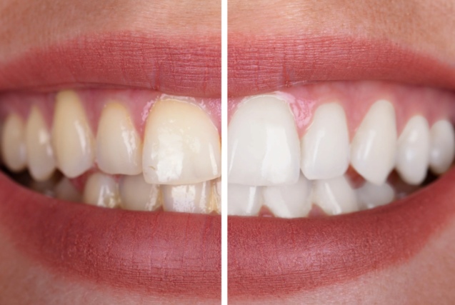 تبيض الاسنان