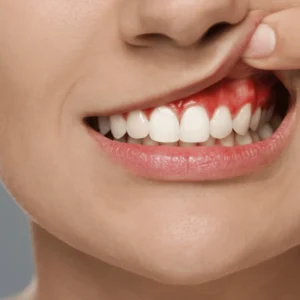 علاج التهاب اللثة 
