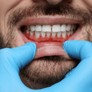 كيف تعالج خراج الاسنان بدون ألم