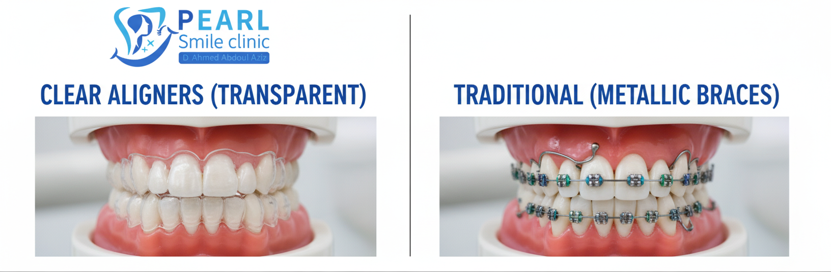سعر التقويم الأسنان